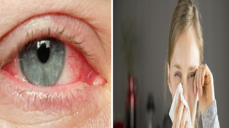 Adopt home remedies to get relief from itching in the eyes news in hindi