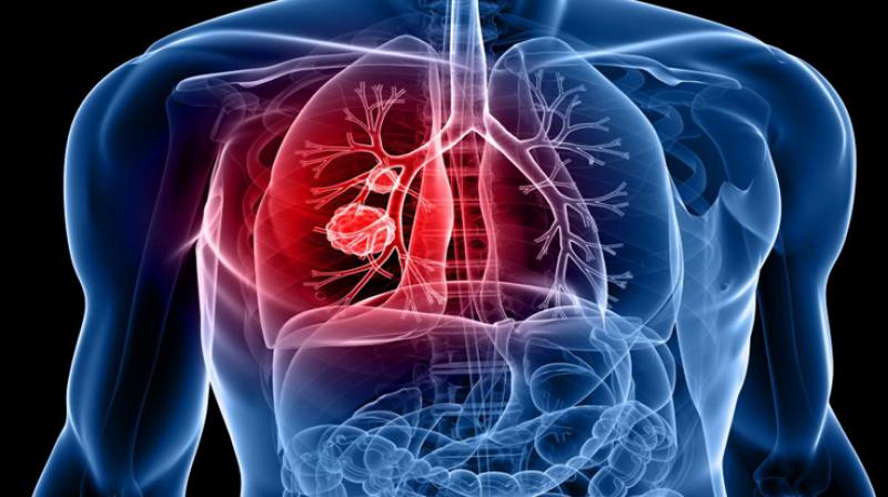 Nobel laureate told this new method to fight lung cancer, know...