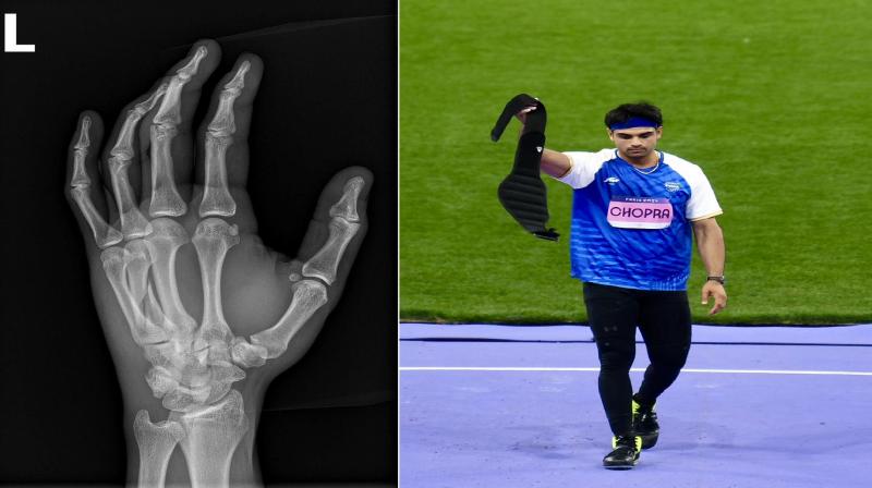 Neeraj Chopra reached Diamond League final even after fracture in hand news in hindi