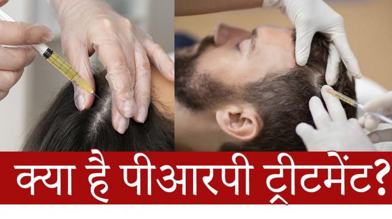 What Is PRP Treatment For Hair Loss And Its Benefits news in hindi